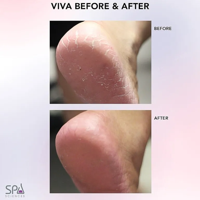 Spa Sciences Viva Advanced Pedicure Foot Smoothing System Callus Remover